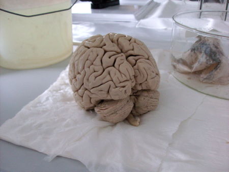 Ein Gehirn in Formalin eingelegt und rechts im Hintergrund die Kopfhaut, 21 k